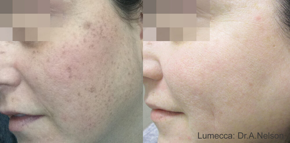IPL Facial