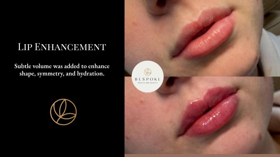 Lip Enhancement