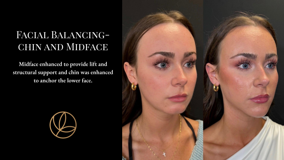 Facial Balancing Chin and Jawline