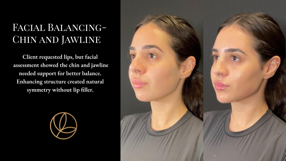 Facial Balancing Chin and Jawline