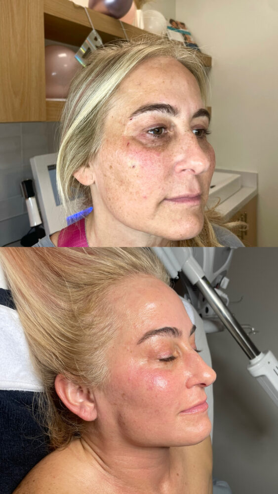 Facial biorepeel
