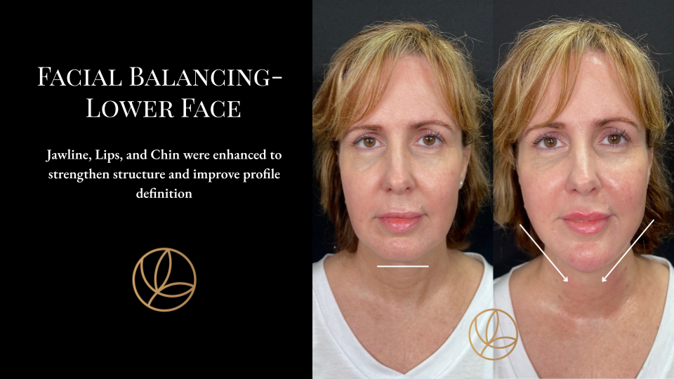 Facial Balancing Lower Face